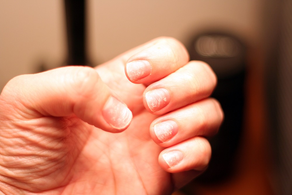 9 Serious Health Problems Your Nails Might Warn You About 1