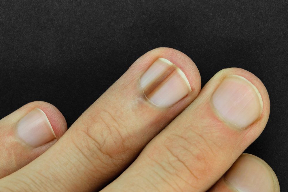 9 Serious Health Problems Your Nails Might Warn You About • Page 2 of 4