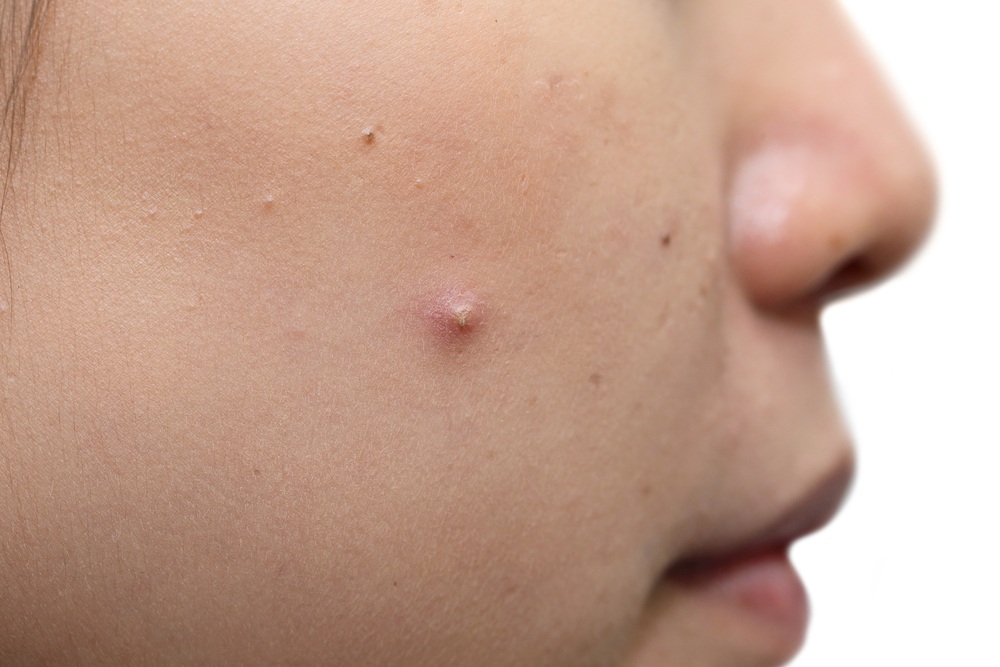Noticed Any Bumps on Your Face? They May Signal These 5 Health Problems 3