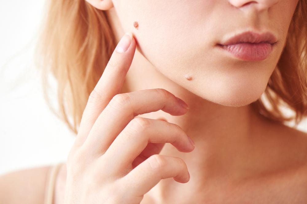 Noticed Any Bumps on Your Face? They May Signal These 5 Health Problems 4